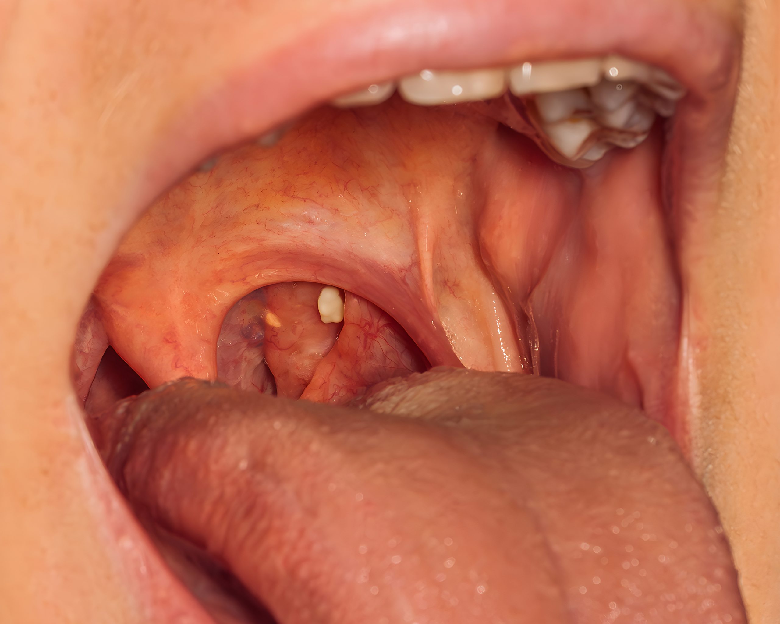 Tonsil Stones: Safe Removal, What Not to Do, and When to See an ENT